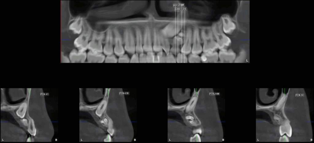 Caso 358 Cortes transaxiales - IDM