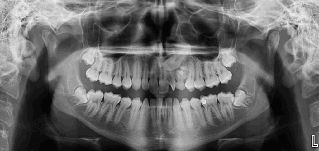 Caso 358 Radiografía panorámica - IDM