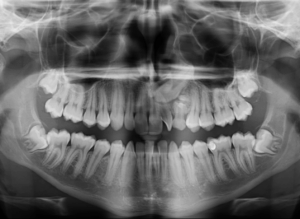 Caso 358 Radiografía panorámica v2 - IDM