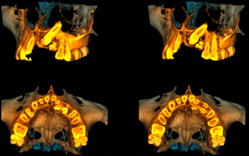 Caso 358 Reconstruccion 3D - IDM