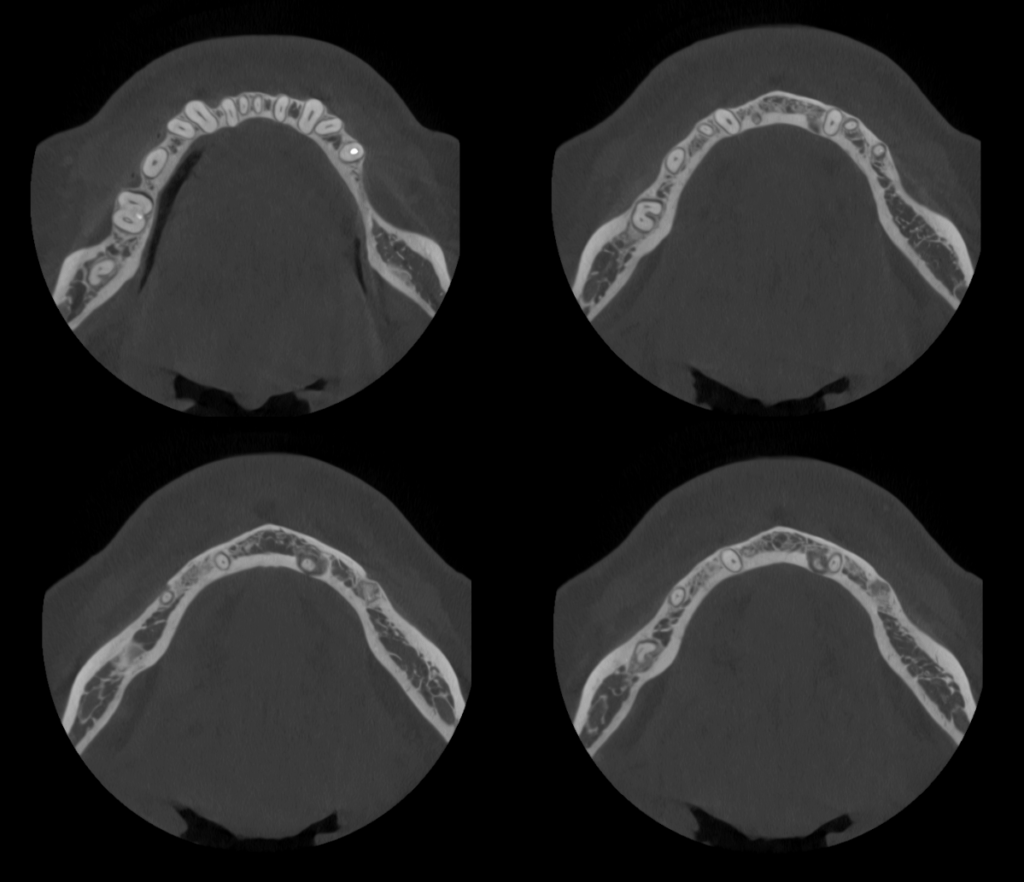Caso 359 Cortes Axiales - IDM