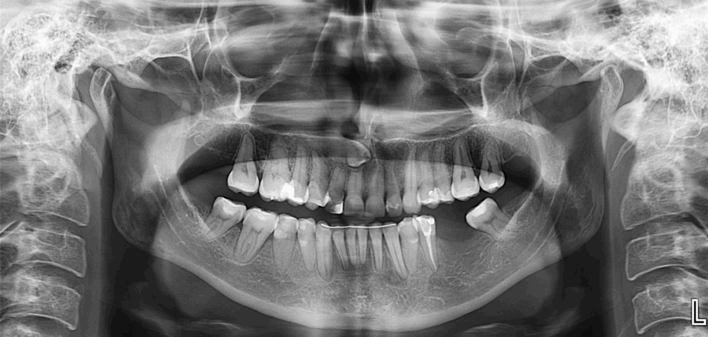 Caso 359 Radiografía panorámica - IDM