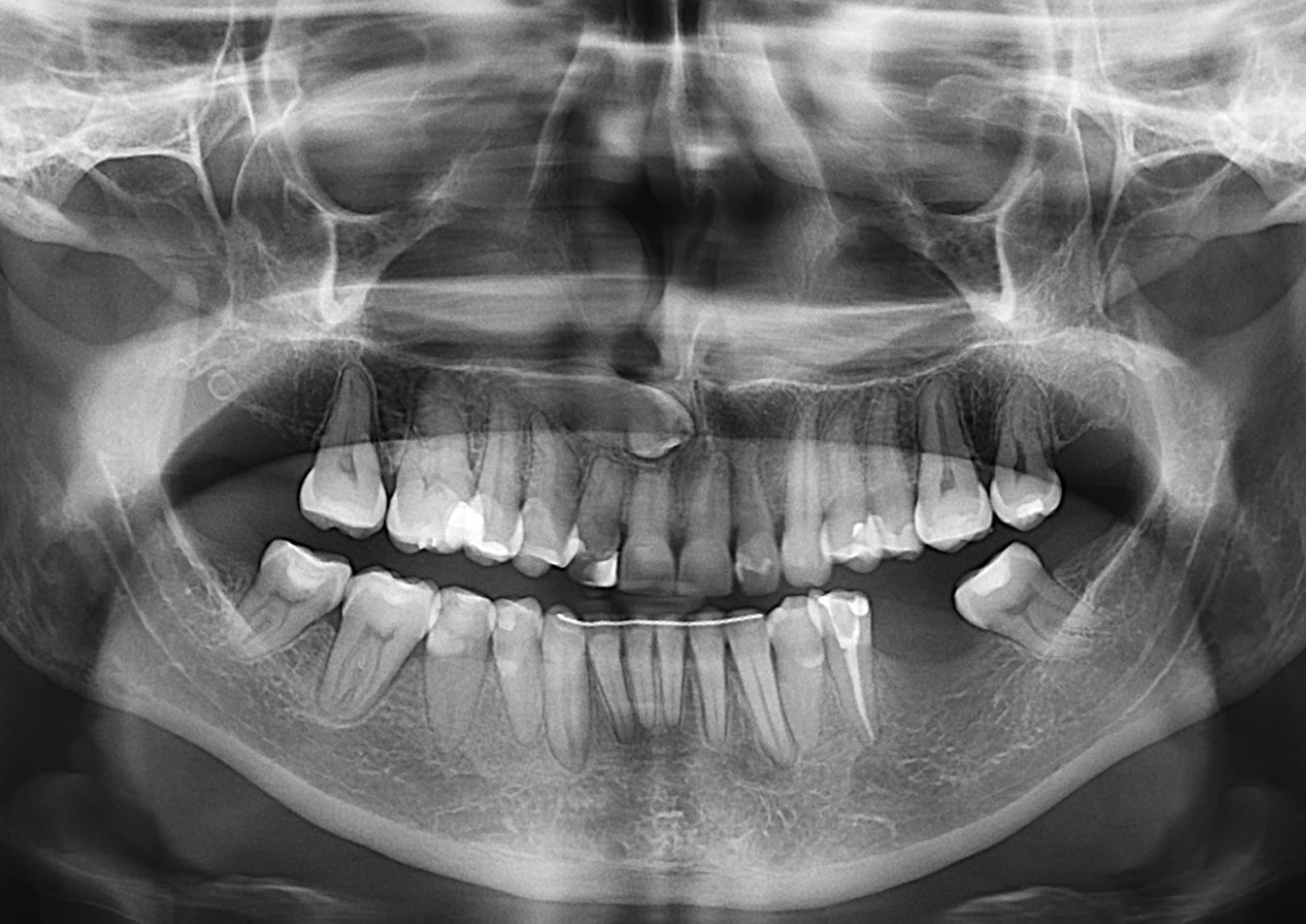 Caso 359 Radiografía panorámica - IDM v2