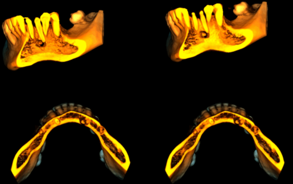 Caso 359 Reconstruccion 3D - IDM