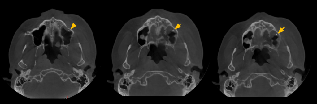 Caso 360 Cortes Axiales - IDM