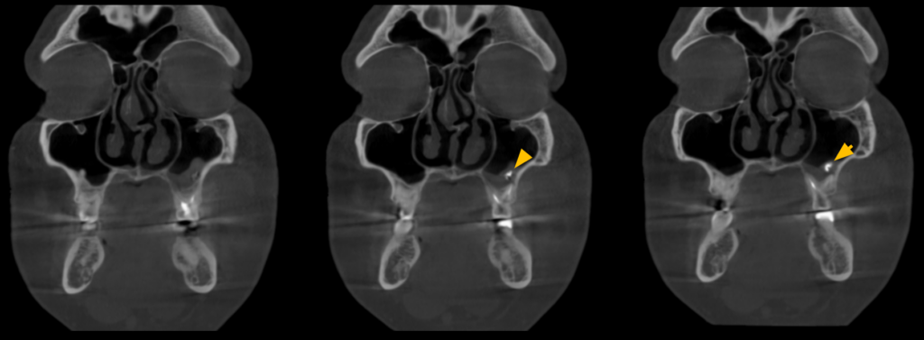 Caso 360 Cortes coronales - IDM