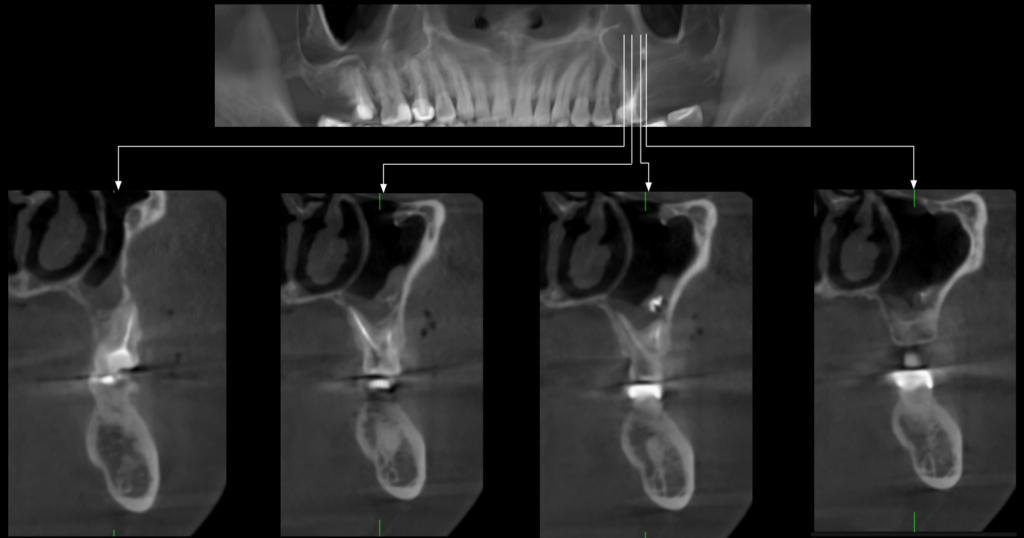 Caso 360 Cortes transaxiales - IDM