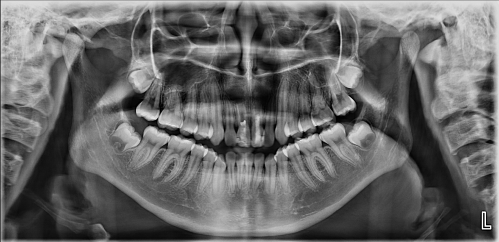 Caso 361 Radiografía panorámica - IDM