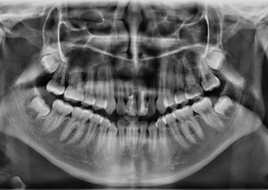 Caso 361 Radiografía panorámica - IDM V2