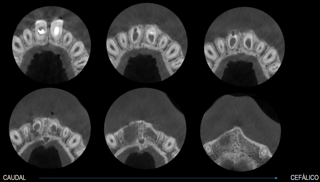 Caso 361 cortes axiales - IDM V2