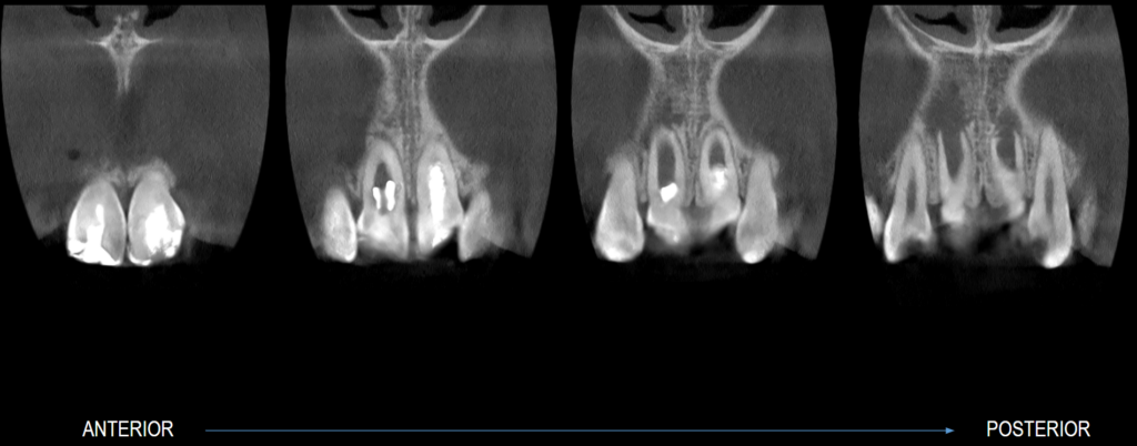 Caso 361 cortes coronales - IDM V2