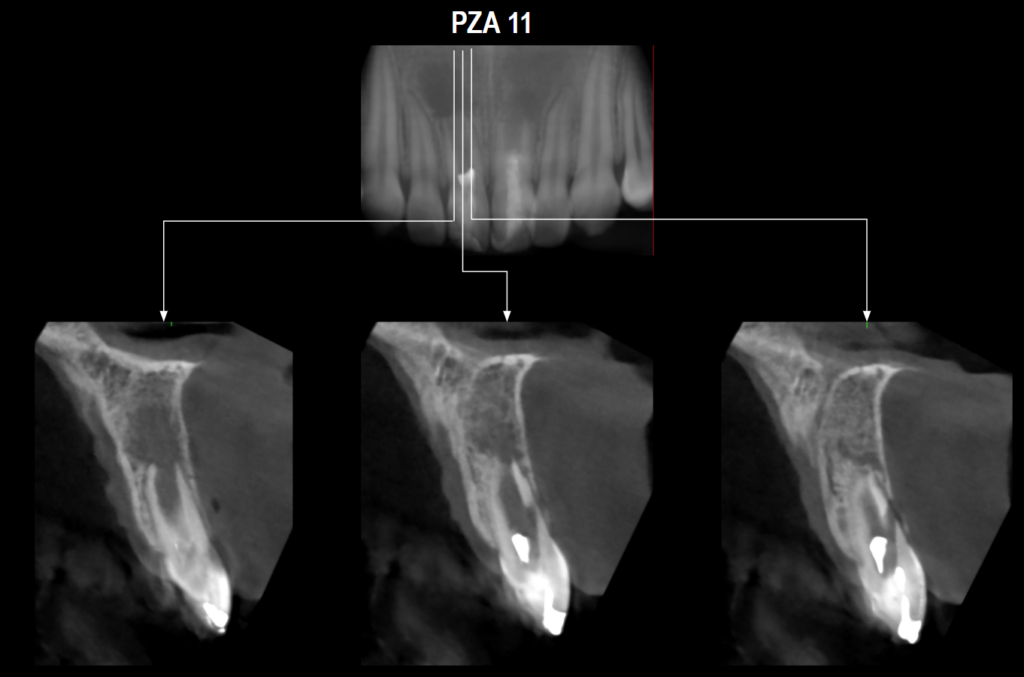 Caso 361 cortes transaxiales - IDM V2