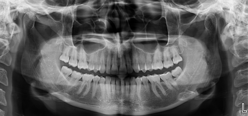 Caso 362 Radiografía panorámica - IDM