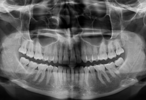 Caso 362 Radiografía panorámica - IDM V2