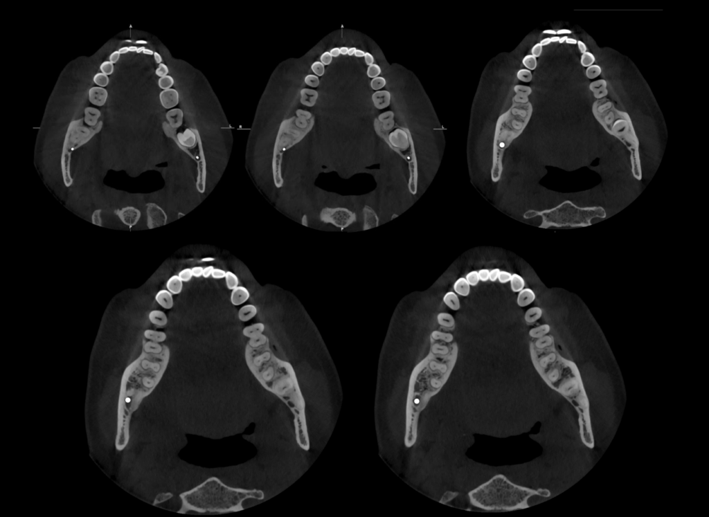 Caso 363 CORTES AXIALES - IDM