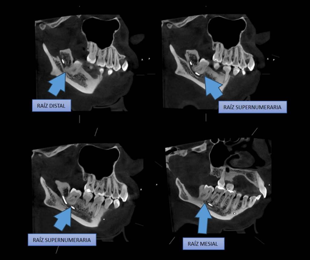 Caso 363 CORTES TANGENCIALES - IDM