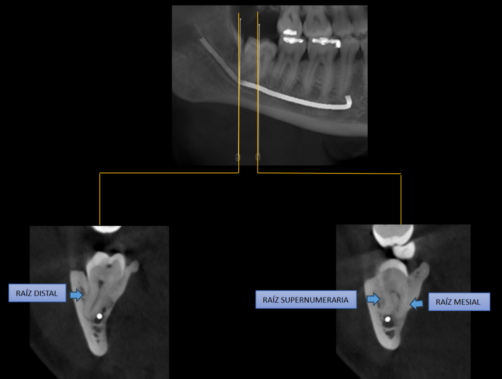 Caso 363 CORTES TRANSAXIALES - IDM