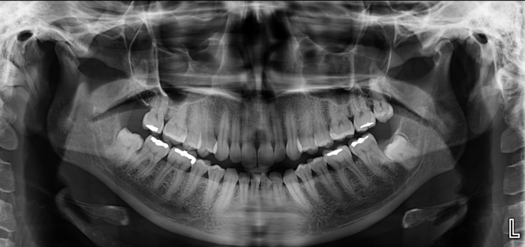 Caso 363 Radiografía panorámica - IDM