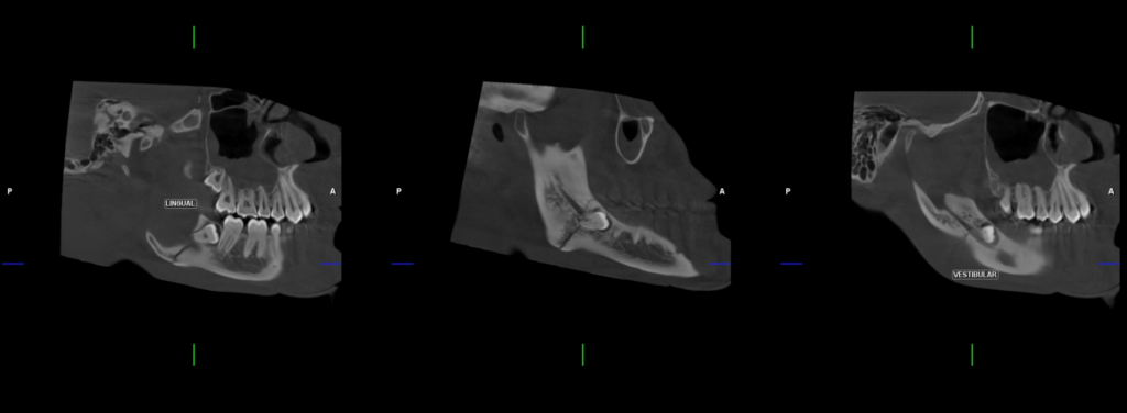 Caso 364 Cortes Tangenciales - IDM