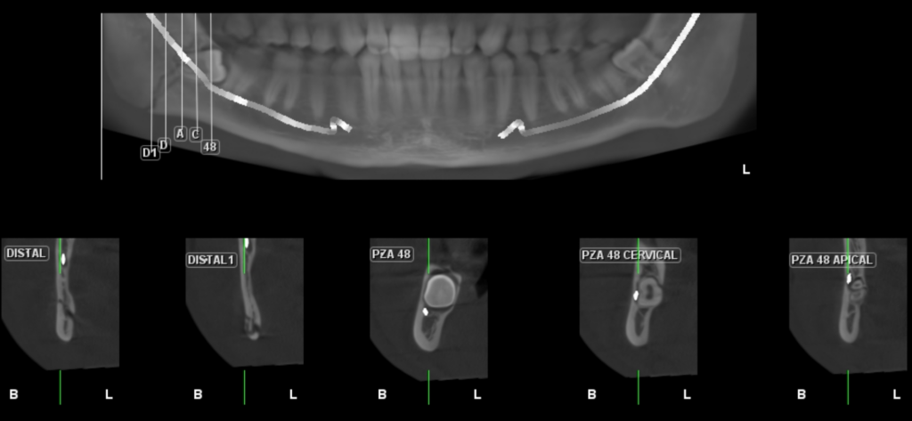 Caso 364 Cortes transaxiales - IDM