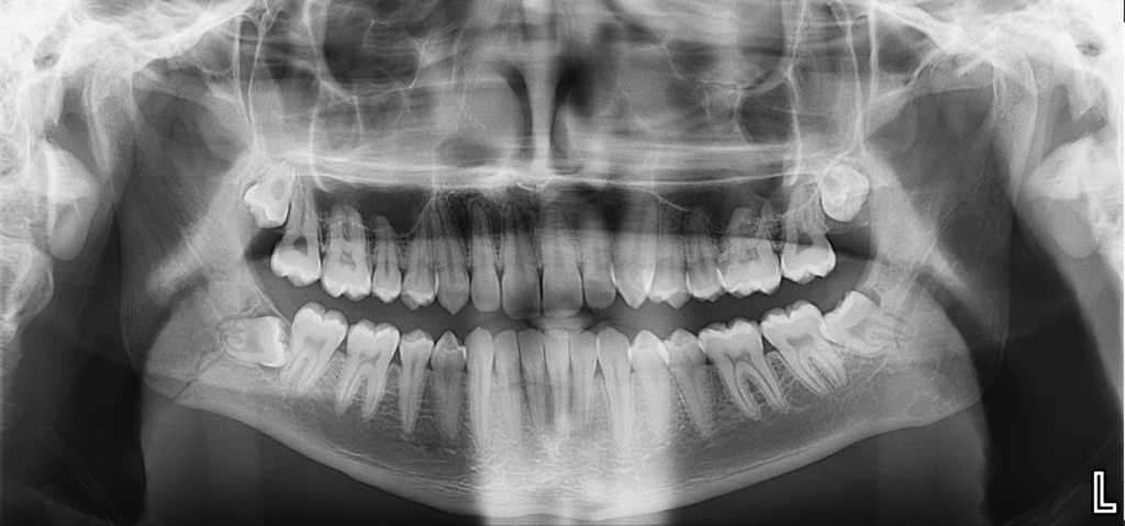 Caso 364 Radiografía panorámica - IDM