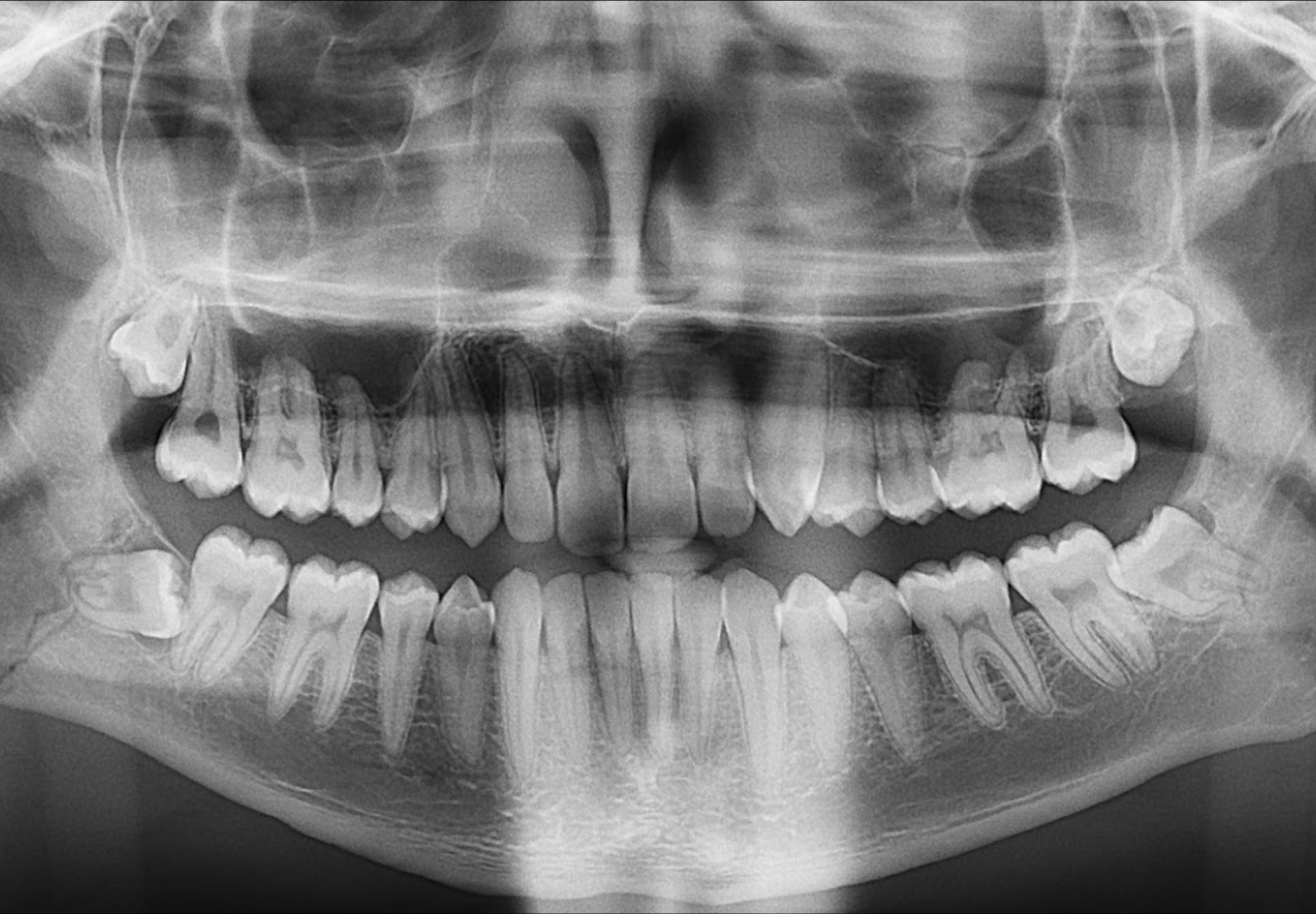 Caso 364 Radiografía panorámica v 2- IDM