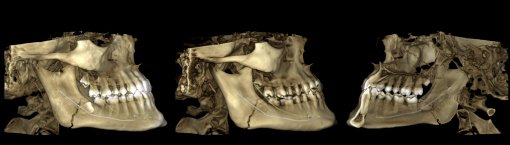 Caso 364 Reconstruccion 3D - IDM