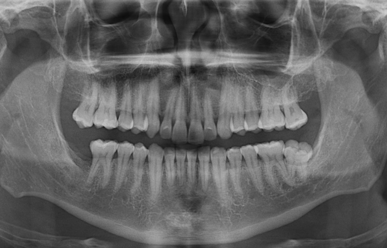 radiografia panoramica caso 367 idm peru 2